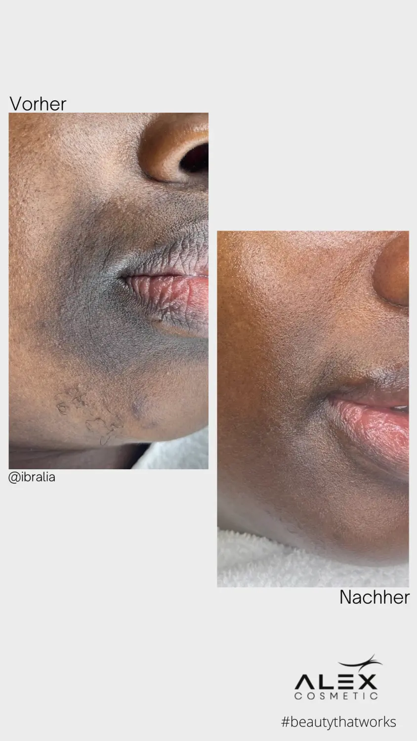 vor und nach der Schönheitsbehandlung